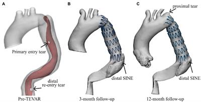 Patient-Specific Virtual Stent-Graft Deployment for Type B Aortic Dissection: A Pilot Study of the Impact of Stent-Graft Length